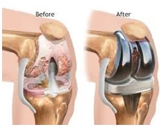 Knee Replacement
