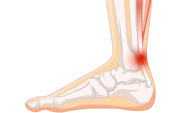 Ankle Injury