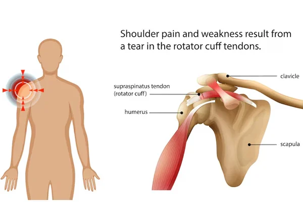 Rotator Cuff Injury