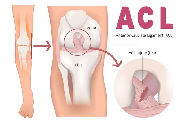ACL Injury